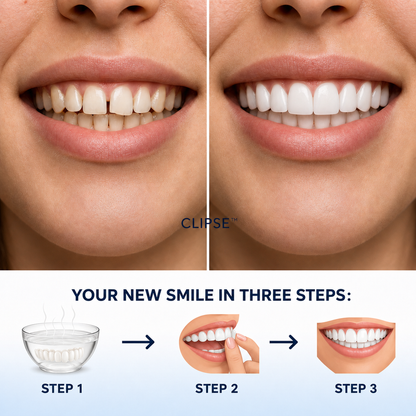 Clipse® Dental Veneers Kit