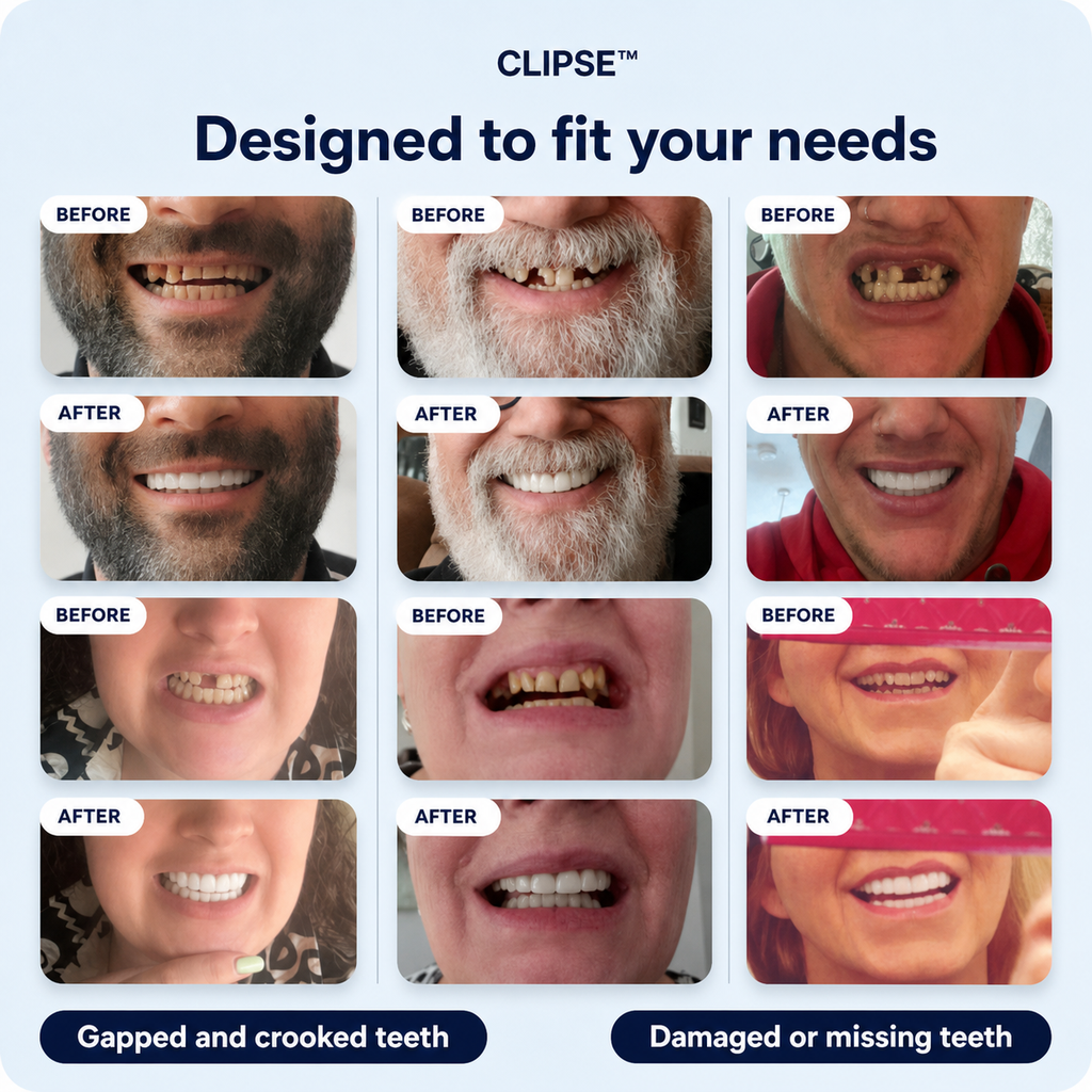 Clipse® Dental Veneers Kit