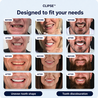 Clipse® Dental Veneers Kit